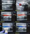 ACUSON 15L8W, (Linear Array) Ultrasound Transducer