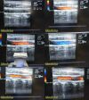 ACUSON Siemens 17L5 HD 10035724 Linear Array Ultrasound Transducer