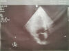 PHILIPS S3-1 Ultrasound Transducer