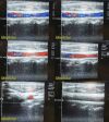 ACUSON 2005  15L8W Linear Array Ultrasound Transducer