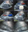 ACUSON 3V2C Phased Array Ultrasound Transducer