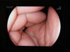 FUJINON EC-590ZP Colonoscope