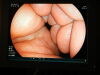 FUJINON LASEREO Endoscopy Processor