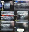 ACUSON 15L8W Linear Array Ultrasound Transducer