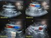 ACUSON 8V5 Sector / Vector Array Ultrasound Transducer