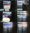 ACUSON (Model 8L5) Linear Array Ultrasound Transducer