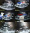 ACUSON 2013  4V1 Phased Array  Probe (08257869) Ultrasound Transducer