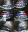 ACUSON 4V1 Vector Array Probe/ Ultrasound Transducer