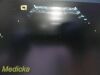ACUSON 2008  8V3 P/N 07695740 Phased Array Ultrasound Transducer
