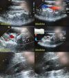 ACUSON Siemens  4V1 Sector Array Ultrasound Transducer