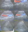 SIEMENS PH4-1 Sector Array Ultrasound Transducer
