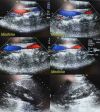 ACUSON 4V1 Phased/Sector Array Ultrasound Transducer