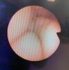 OLYMPUS BF-N20 Bronchoscope