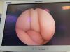 OLYMPUS BF-1T60 Bronchoscope