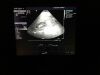 SIEMENS 4V1 Ultrasound Transducer