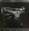 SIEMENS 17L5 Ultrasound Transducer