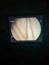 FUJINON ED530XT8 Duodenoscope