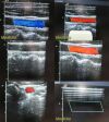 SIEMENS Acuson  Medical 6L3 Linear Array Ultrasound Transducer