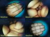 JARIT 10mm x 0° Rigid Telescope Laparoscope