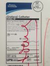 BOSTON SCIENTIFIC 400-236 Spiral Tip Ureteral Catheter 5F x 70cm (20/Box) (X)