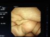 OLYMPUS GF-UCT140 Gastroscope
