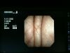 OLYMPUS ENF-VT Rhinolaryngoscope