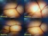 WOLFE 8650.35 Lumina 4mmx70° Rigid Telescope Cystoscope