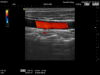 HITACHI L65 Ultrasound Transducer