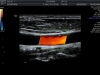 GE 11L-D Ultrasound Transducer