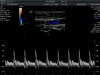 GE 11L-D Ultrasound Transducer