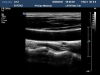 PHILIPS L9-3 Ultrasound Transducer