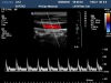 PHILIPS L9-3 Ultrasound Transducer