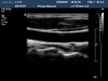 PHILIPS L17-5 Ultrasound Transducer