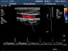 PHILIPS L17-5 Ultrasound Transducer