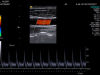 SIEMENS 14L5 SP Ultrasound Transducer