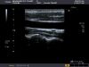 TOSHIBA PLT-704SBT Ultrasound Transducer