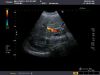 TOSHIBA PVT-674BT Ultrasound Transducer