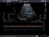 TOSHIBA PVT-674BT Ultrasound Transducer