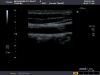 TOSHIBA PLT-604AT Ultrasound Transducer
