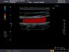 TOSHIBA PLT-604AT Ultrasound Transducer