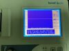 SUMMIT DOPPLER AVS Vista Doppler Waveform Analyzer