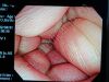OLYMPUS PCF-Q260AI Colonoscope