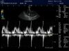 GE 5S Ultrasound Transducer