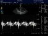 GE 5S Ultrasound Transducer