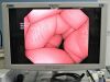 OLYMPUS CF-Q180AL Colonoscope