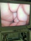 STRYKER 1188 , x8000 . Laparoscopy tower