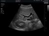 HITACHI CA2-8AD-H Ultrasound Transducer