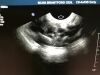 PHILIPS IU 22 Ultrasound Transducer