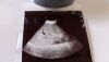 GE EM6C Ultrasound Transducer