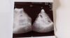 GE EM6C Ultrasound Transducer